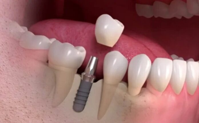 How to Prepare Yourself before Getting Dental Implants